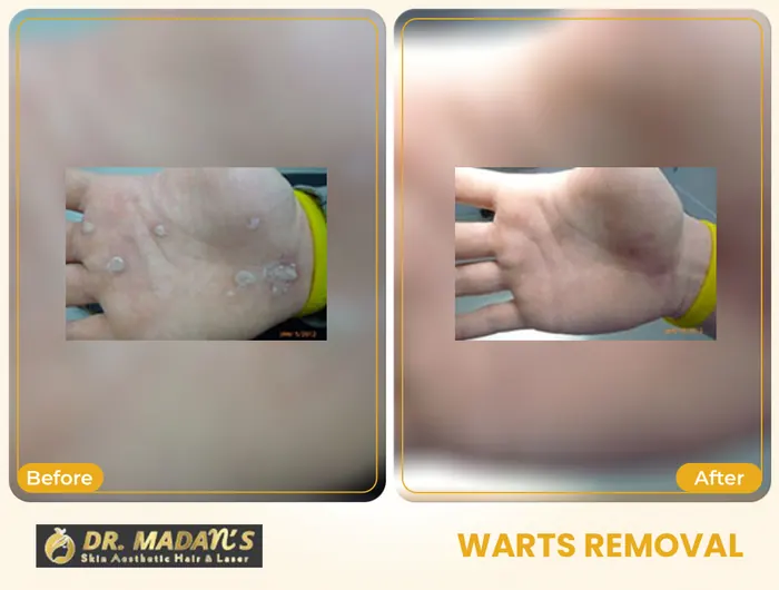 Warts removal before and after result 5 at Dr Madan Aesthetics